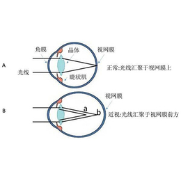 健瞳公司|散光|散光眼