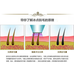 冰点台式OPT激光脱毛仪销售-脱毛*嫩肤祛斑吉林冰点脱毛仪