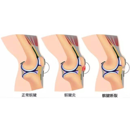膝关节正骨-建邺膝关节-冷水医学科技