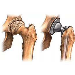 髋关节扁平-冷水医学科技(在线咨询)-南京髋关节