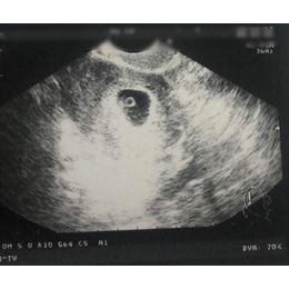 卵巢早衰amh低于1试管婴儿移植成功